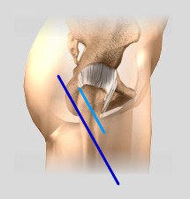 Comparison of Minimally Invasive Hip Surgery and Traditional Hip Surgery Incisions