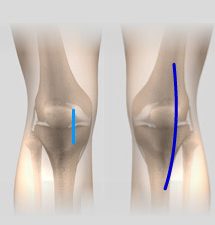 Comparison of Minimally Invasive Knee Surgery and Traditional Knee Surgery Incisions